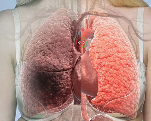 Phổi là một trong những cơ quan quan trọng nhất trong cơ thể.Khi hút thuốc lá thì phổi của bạn lấp đầy bởi 4.000 hóa chất độc hại, nguy hiểm nhất là phải kể đến nicotine và hắc ín tức là nhựa thuốc lá.  Nicotine là chất không màu nhưng khi đi vào phổi nó chuyển thành màu nâu, chất này gây nghiện, giảm lượng oxy trong máu, vô cùng nguy hại đối với sức khỏe và phổi.  Nhựa thuốc lá hay còn gọi là hắc ín chính là nguyên nhân dẫn đến phổi của người hút thuốc lá bị nám đen và là nguyên nhân chính gây nên khó thở, bệnh phổi tắc nghẽn mãn tính và tồi tệ hơn là căn bệnh ung thư phổi .  Trong thịt quả hồng màu vàng cam chứa rất nhiều Beta-caroten và giúp loại bỏ nhanh nicotine ra khỏi cơ thể và thanh lọc những chất độc bám ở phổi . Qủa hồng cũng là một loại trái cây tốt để đào thải độc tố của thuốc lá ra khỏi cơ thể và ngăn ngừa ung thư phổi.  Hãy duy trì ăn 3-4 quả hồng mỗi ngày để giúp phổi bạn khỏe hơn mỗi ngày, bên cạnh đó bạn cần cai nghiện thuốc lá để sống khỏe và thọ hơn nhé.